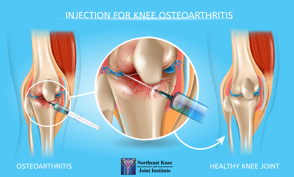 knee gel injections near me