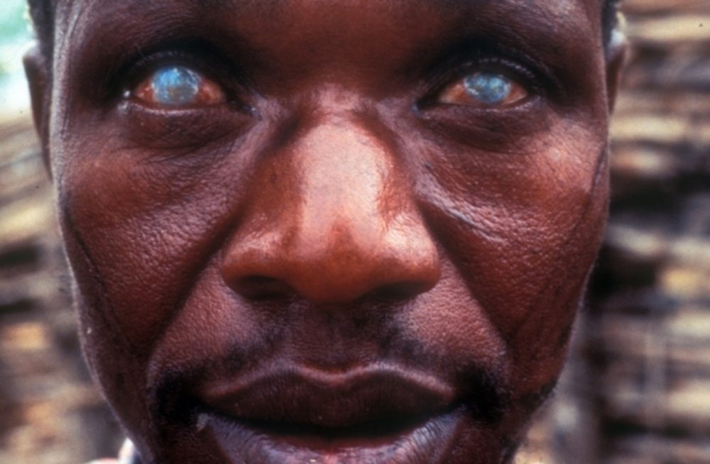 What Causes and Treatments River Blindness?