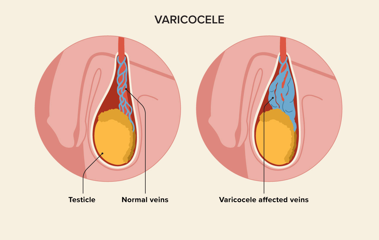 varicocele diet