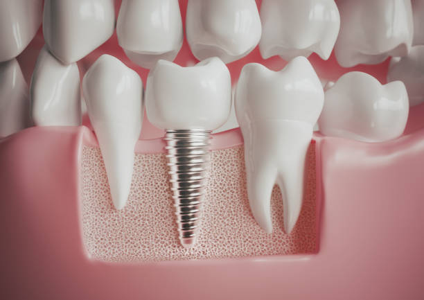 How Much Do Dental Implants Cost in Pakistan? A Comprehensive Overview