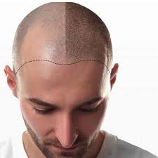 Hair Transplant Cost in Riyadh