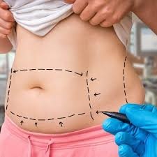 Liposuction Surgery in Dubai