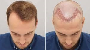 Hair Transplant in Dubai