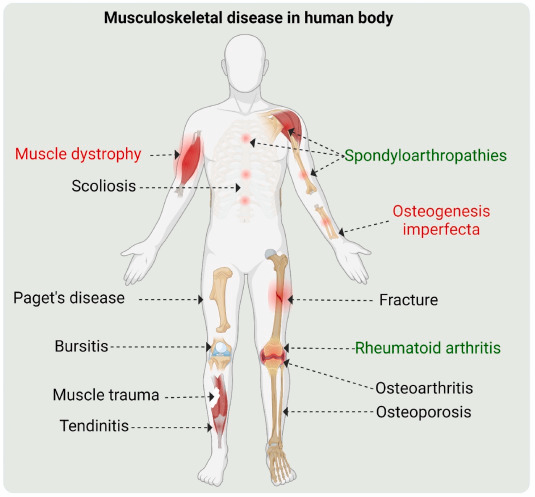 Musculoskeletal Disorders in human