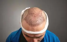 Hair Transplant in Riyadh